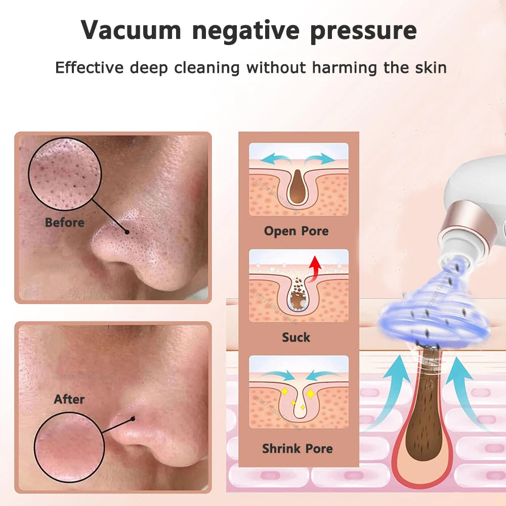 Electric Vacuum Blackhead Remover